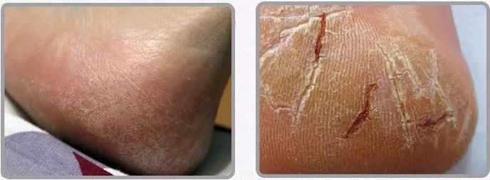 快速修复手干裂,冬季皮肤干燥脱皮面霜