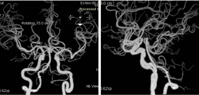 椎动脉起始段狭窄的介入治疗ppt,椎动脉v4段假性动脉瘤介入治疗