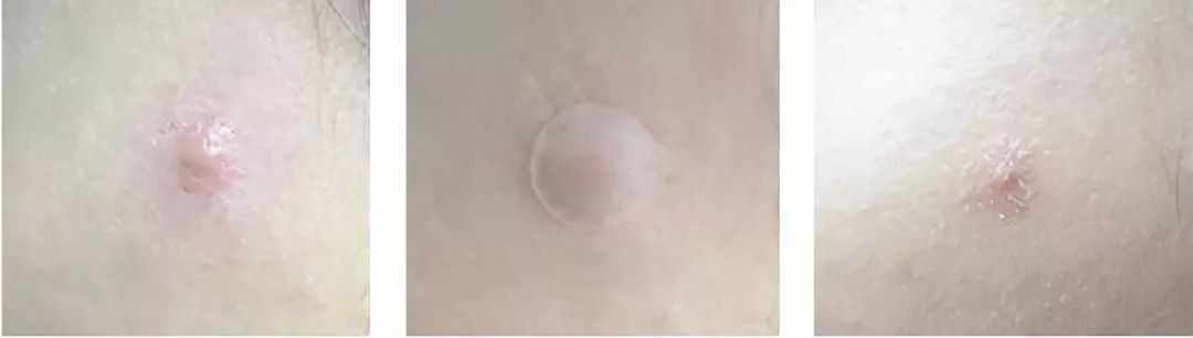 推荐的祛痘面膜青春期,祛痘紧急修复面膜