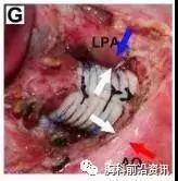 唐都医院支架手术怎么样,唐都医院气管支架