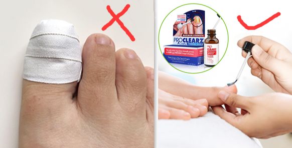 十年灰指甲可以治好吗,一次搞定顽固灰指甲