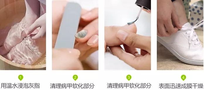 十年灰指甲可以治好吗,一次搞定顽固灰指甲