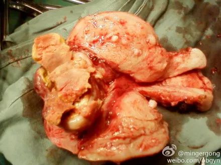 子宫腺肌症消融有效果吗,腺肌症和子宫肌瘤可以保守治疗吗