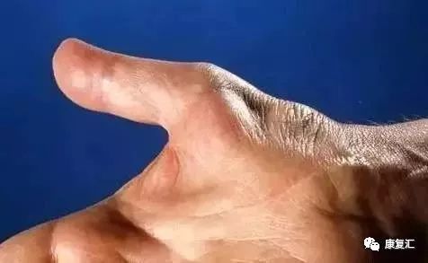 鼠标手康复科普文章,鼠标手的康复和治疗