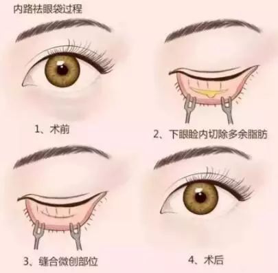 千万别把眼袋当卧蚕,倪海厦中医讲堂说眼袋