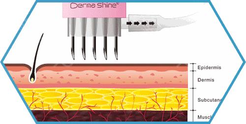 医美微针有什么效果,配合微针做的医美产品有哪些