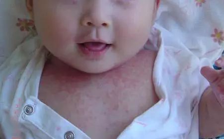 宝宝“湿疹”反复发作治不好?小心是特应性皮炎惹的祸!