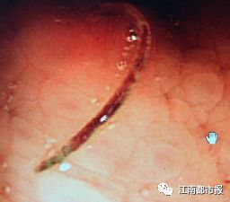 女子一周便血,大量便血真实案例