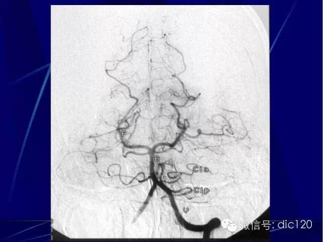 脑血管解剖技巧,脑血管解剖与介入