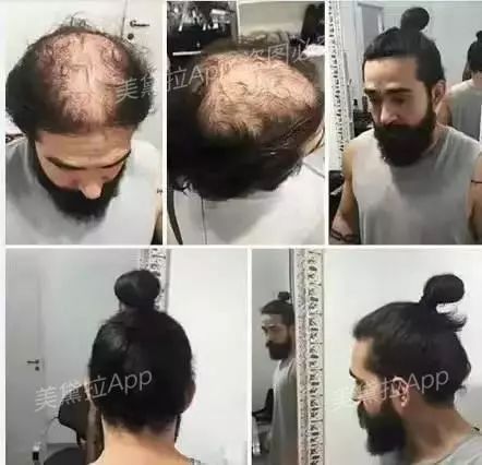 头等大事脱发青年自救指南,秃头女孩必看6大脱发误区