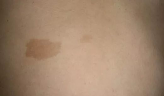 欧诗漫美白淡斑和净白淡斑的区别,真正有效的美白淡斑