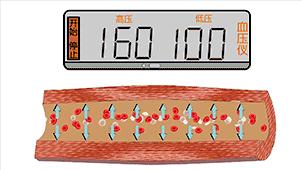 血管堵演示,血管堵塞100张图片