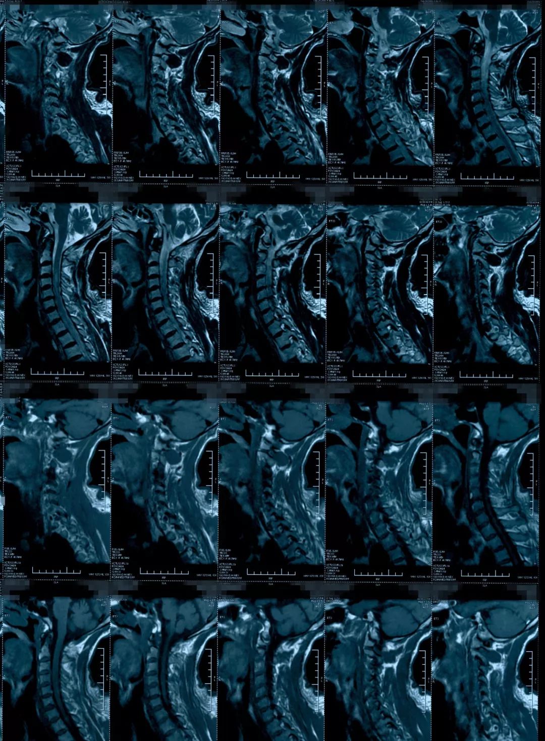 椎管狭窄水肿最佳治疗方法,椎管水肿如何治疗