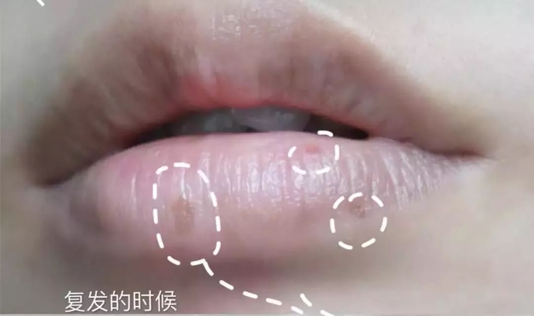 干裂救星护手霜,唇干裂用什么润唇好