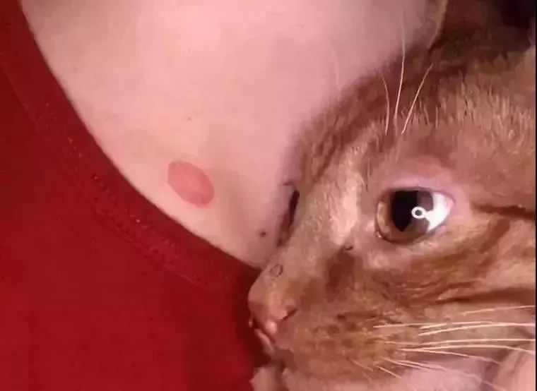 猫癣传染了给人该怎么办,人被传染上猫癣能用皮特芬吗