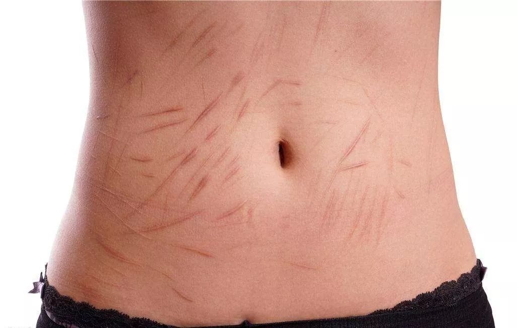 治疗疤痕的新*器武**——CO2点阵激光