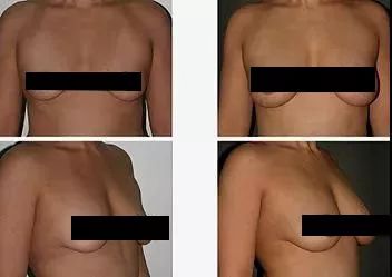 隆胸风险大还是缩胸大,胸大重要还是瘦重要