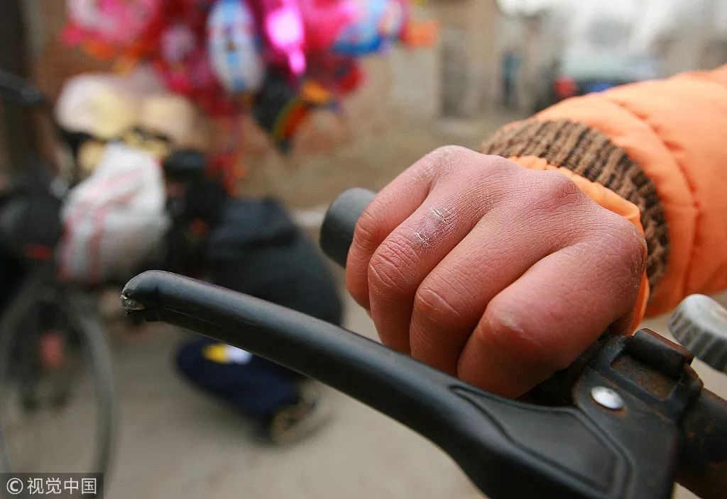 在寒冷的地方呆久了会有什么症状,在寒冷区待久了鼻子会变挺吗