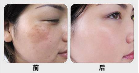 ‘斑’弄是非，超皮秒要你好看