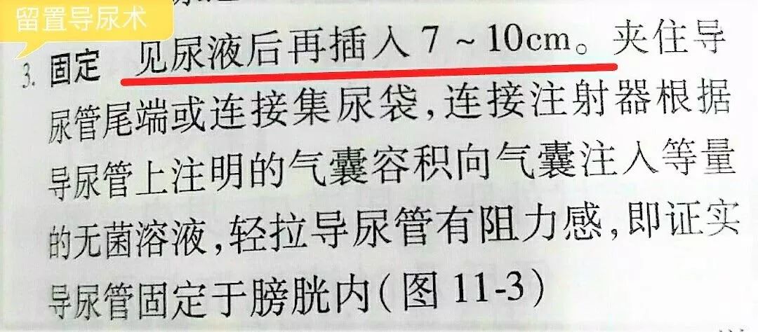 术后留置导尿漏尿的护理措施,导尿管旁漏尿如何处理老年人