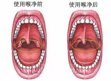 20年烟民咽喉发黑,瑞士专业医师推荐!一喷杀菌99.9%,止咳清痰排烟毒