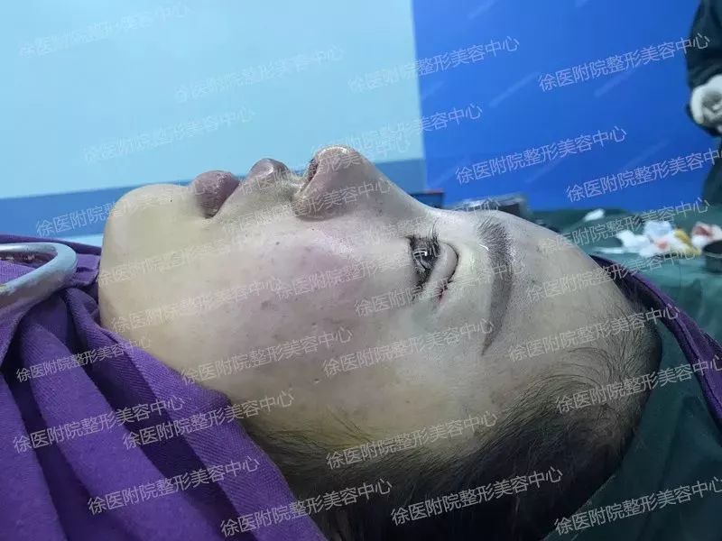 双眼皮失败又不想修复怎么办,双眼皮失败修复方法如下