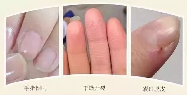 手足脱皮脚后跟干裂修复膏,奇迹第十代