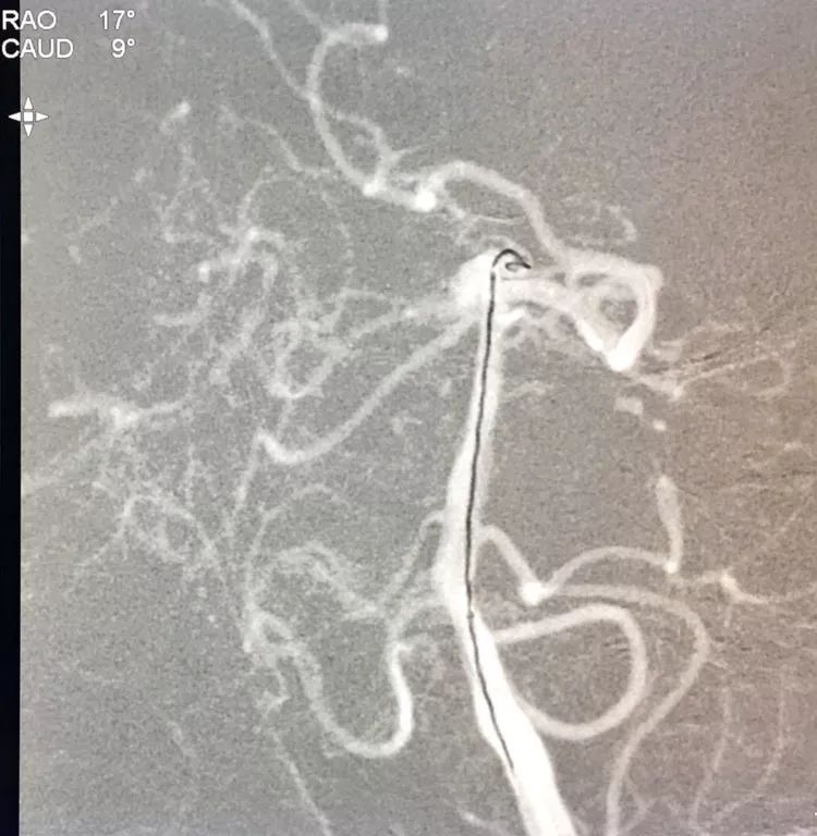 柳暗花明专栏|栓塞颅内动脉瘤时微导管无法穿过LVIS支架网眼怎么办
