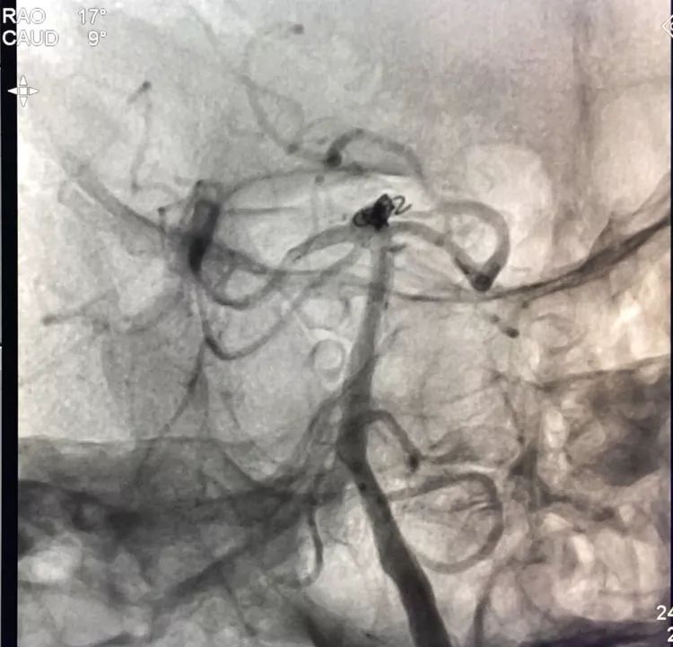 柳暗花明专栏|栓塞颅内动脉瘤时微导管无法穿过LVIS支架网眼怎么办