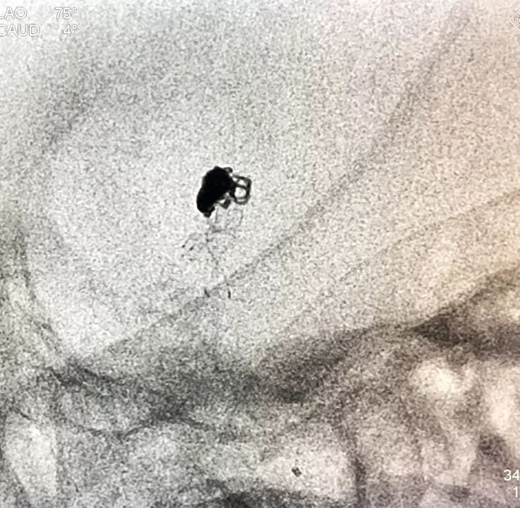 柳暗花明专栏|栓塞颅内动脉瘤时微导管无法穿过LVIS支架网眼怎么办