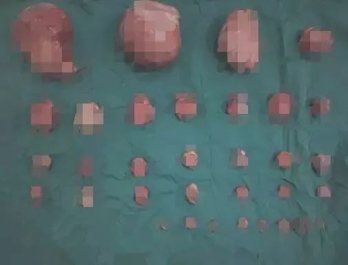 未婚女孩怀孕肚子变大,女子突然发现怀孕7个月