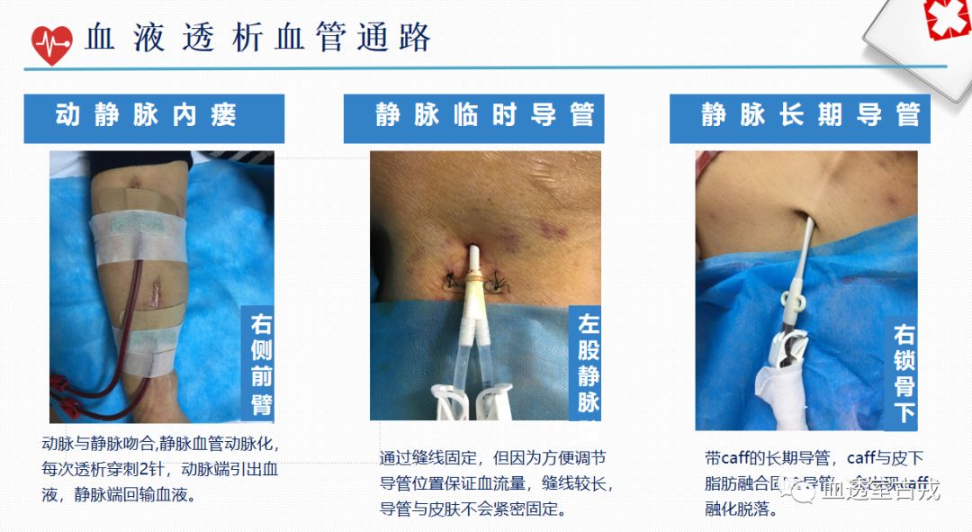 透析穿刺针脱落整改措施,透析过程中穿刺针滑脱怎么办