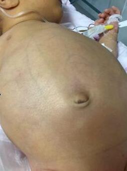 宝宝刚出生就做手术,宝宝出生之后要做小肠手术