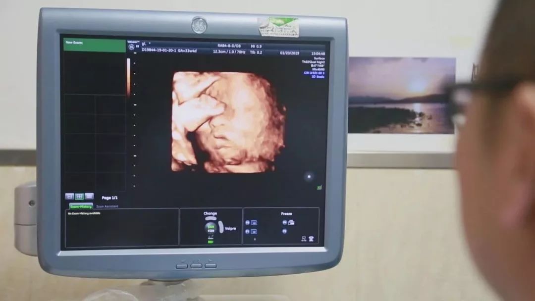 中国首例母亲移植子宫给女儿,中国首例试管女自然受孕