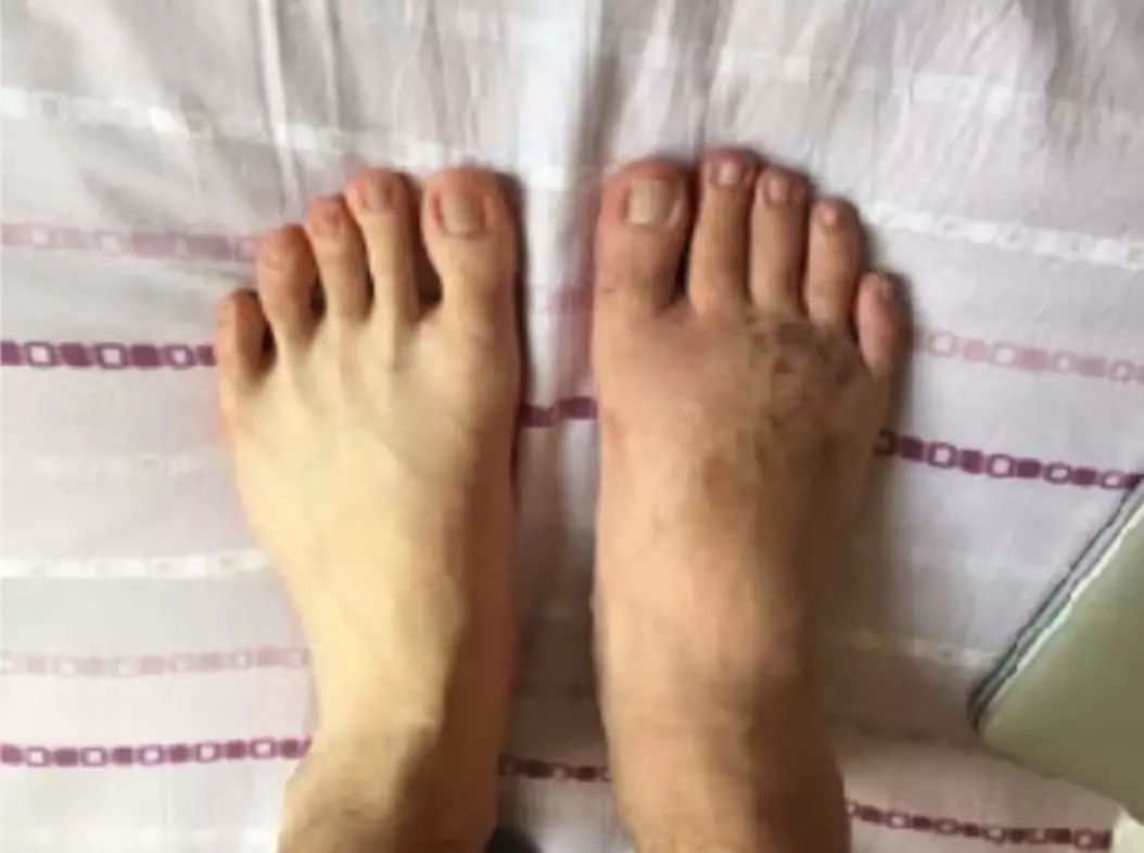 俄罗斯留学生骨折截肢,留学生意外被截肢