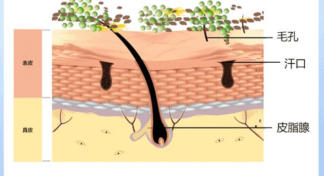 拨黑头工具草莓鼻,去黑头神器真的能吸出黑头
