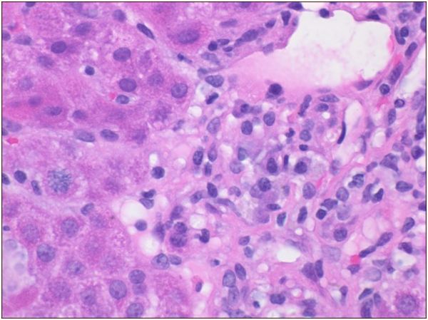米诺环素引起的肝损害怎么办,药物诱发自身免疫性肝炎