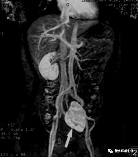肾脏形态变异怎么办,肾脏疾病鉴别五项意义