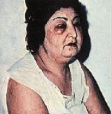 人感染旋毛虫后对人的危害有哪些,提醒别碰几种蔬菜寄生虫多到成堆