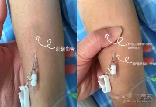 针拔出来血管就可以愈合吗,拔针把血管戳破了咋办