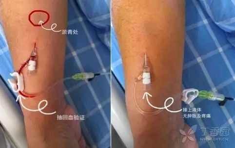 输液刺破血管补救办法,打针刺破血管是如何恢复的