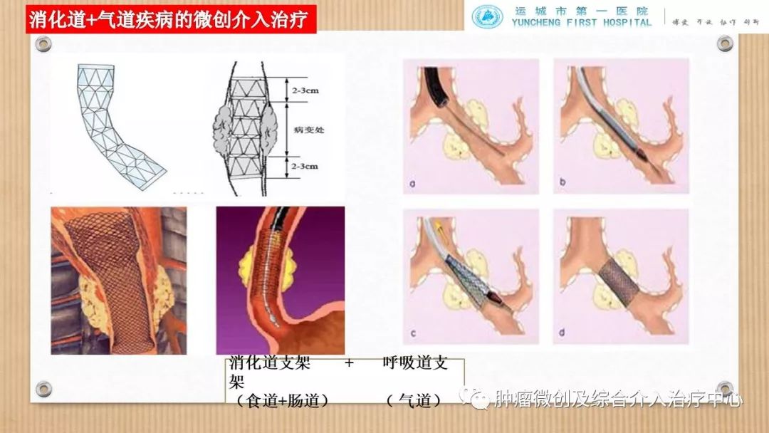 脾动脉栓塞术,脾栓塞手术的适应症