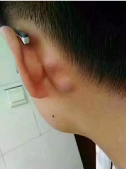 你的耳后有鼓包吗赶紧对照看看,耳后有个鼓包怎么回事