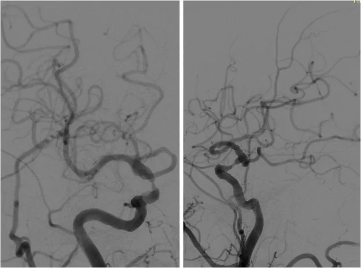 椎动脉v4段血管瘤介入治疗,臭氧治疗左侧v4段椎动脉狭窄