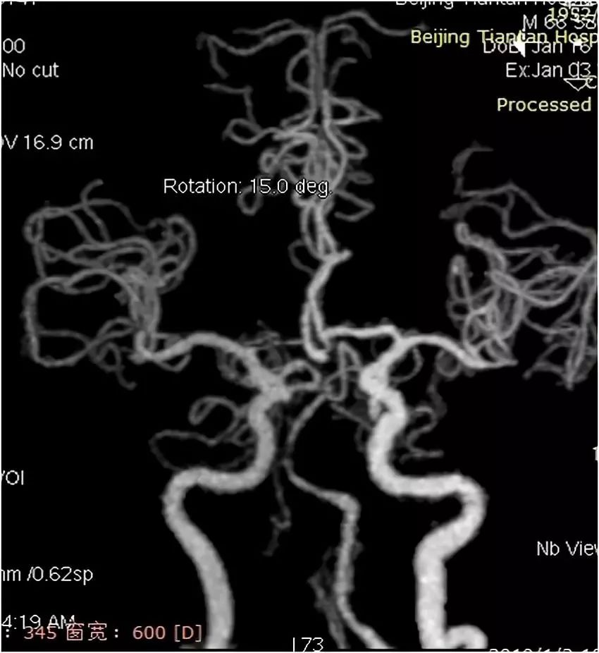 椎动脉v4段血管瘤介入治疗,臭氧治疗左侧v4段椎动脉狭窄