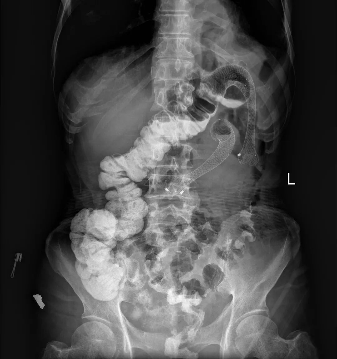 消化道支架置入术,消化道梗阻支架怎么放