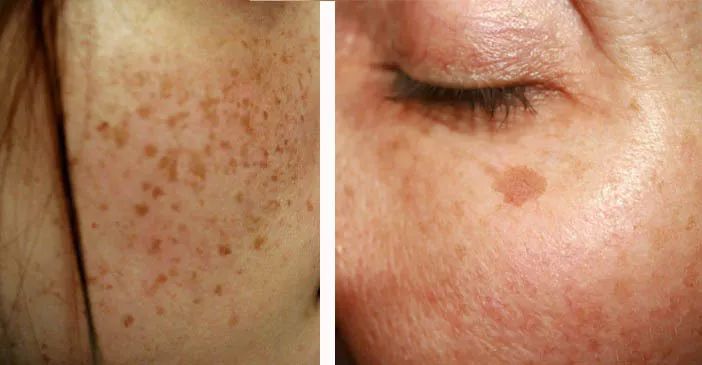 5个祛斑小妙招淡化晒斑雀斑痘印,晒斑痘印怎么消除的最快方法