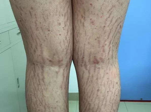 7岁儿童身上长黑毛,孩子身上长了很多黑毛怎么回事