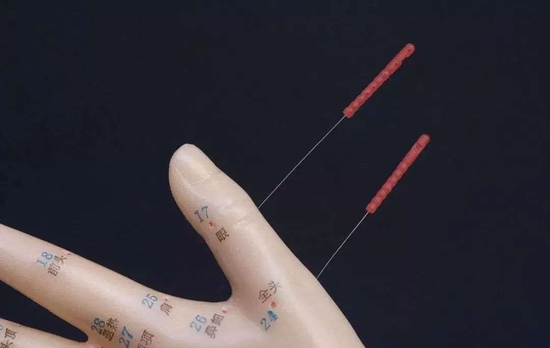 更年期月经淋漓不尽针灸,缓解更年期焦虑做针灸多久才有效