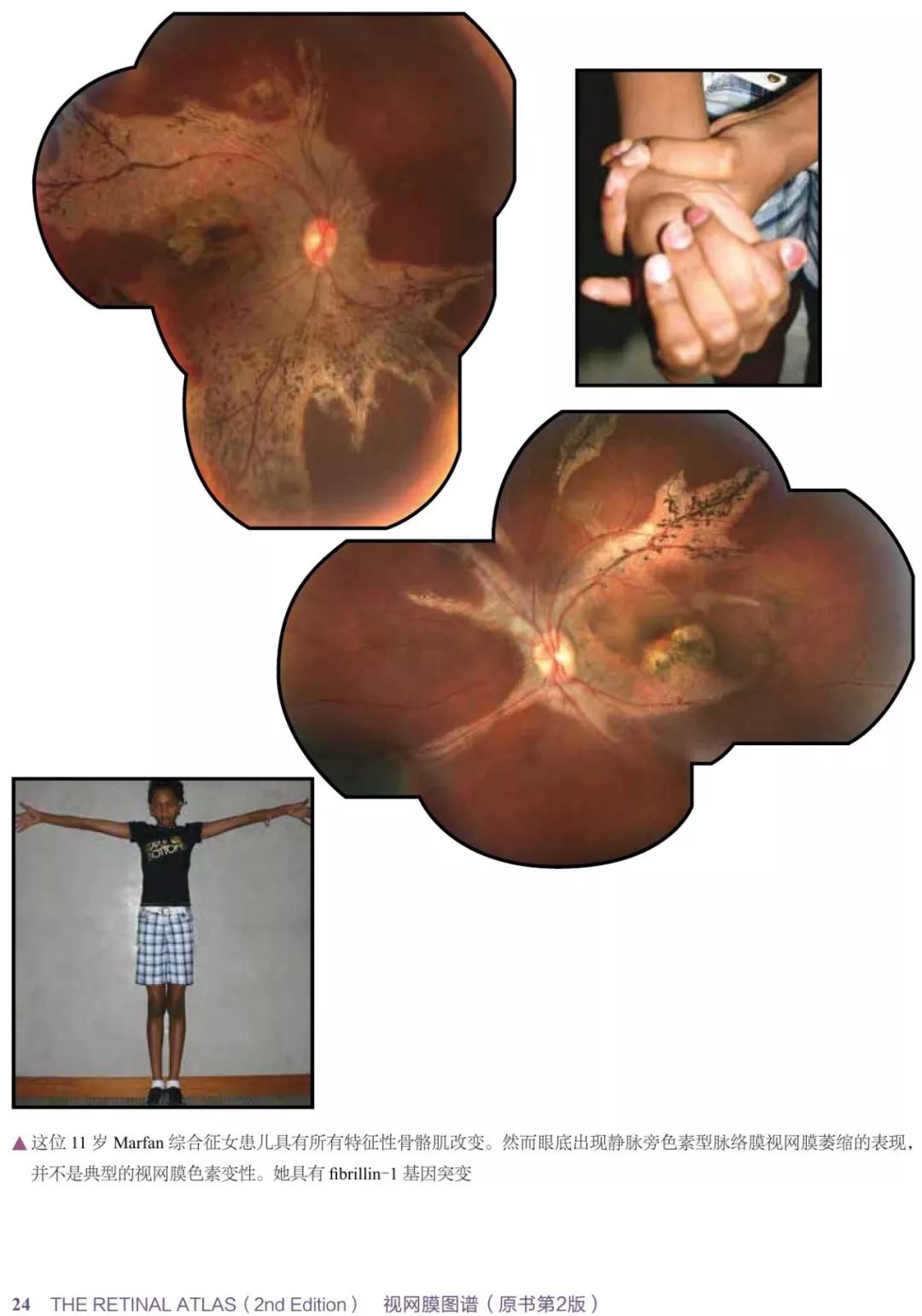 眼底病变眼睛图片,眼底病变的高清挂图